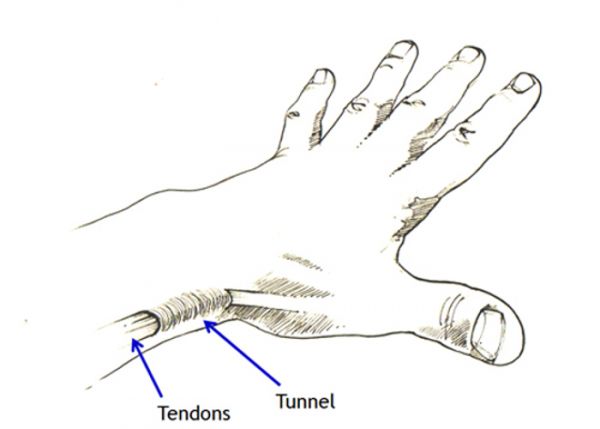 De Quervain's Syndrome - The Hand Clinic